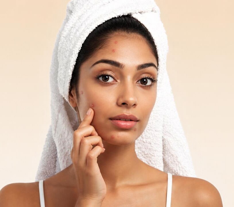 Image of Acne Treatment Guide: When to DIY and When to See a Dermatologist