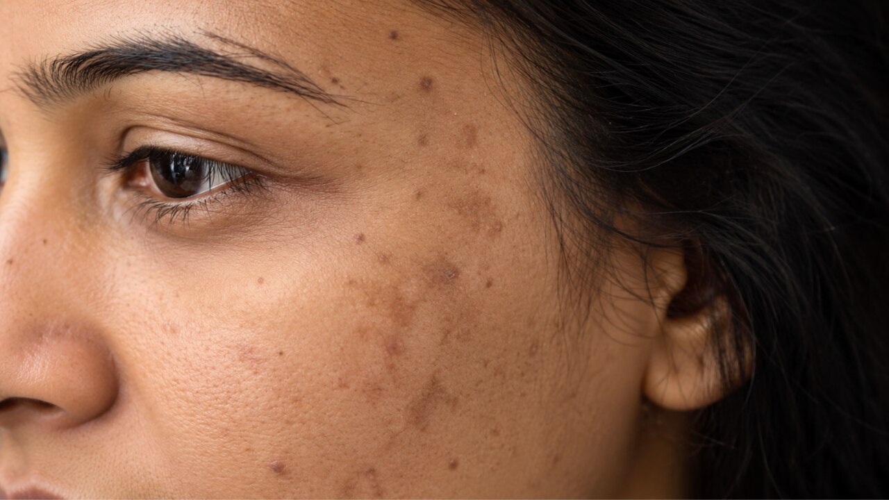 Melasma