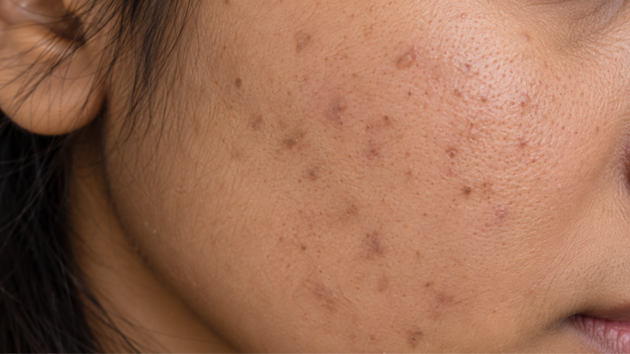 Post-inflammatory pigmentation