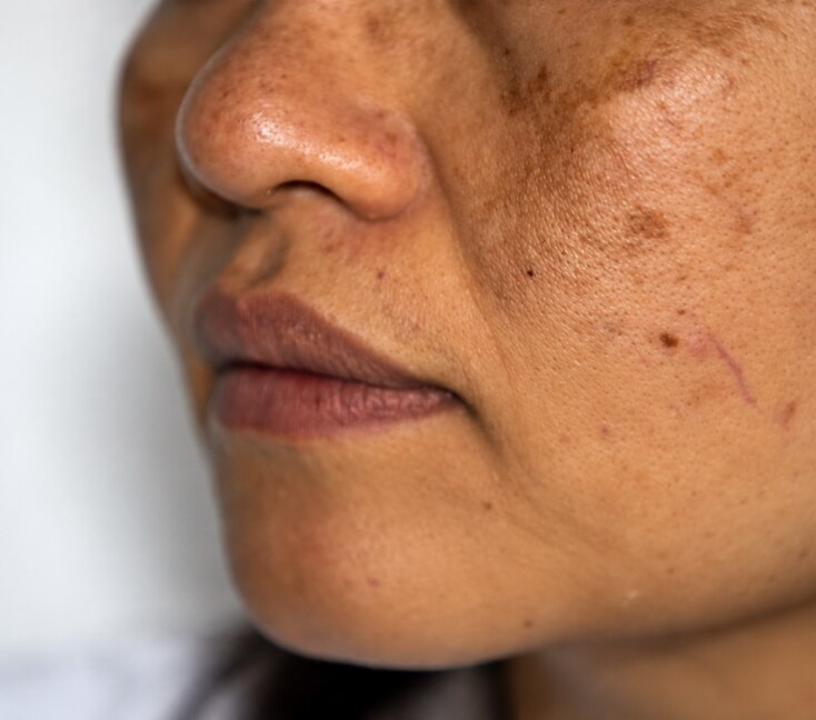 Image of Dark Spots on Face: How to Prevent New Marks and Fade Existing Ones
