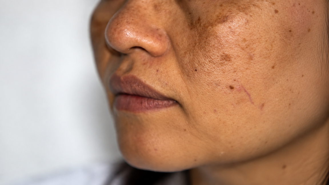 Dark Spots on Face Causes, Treatment and Prevention