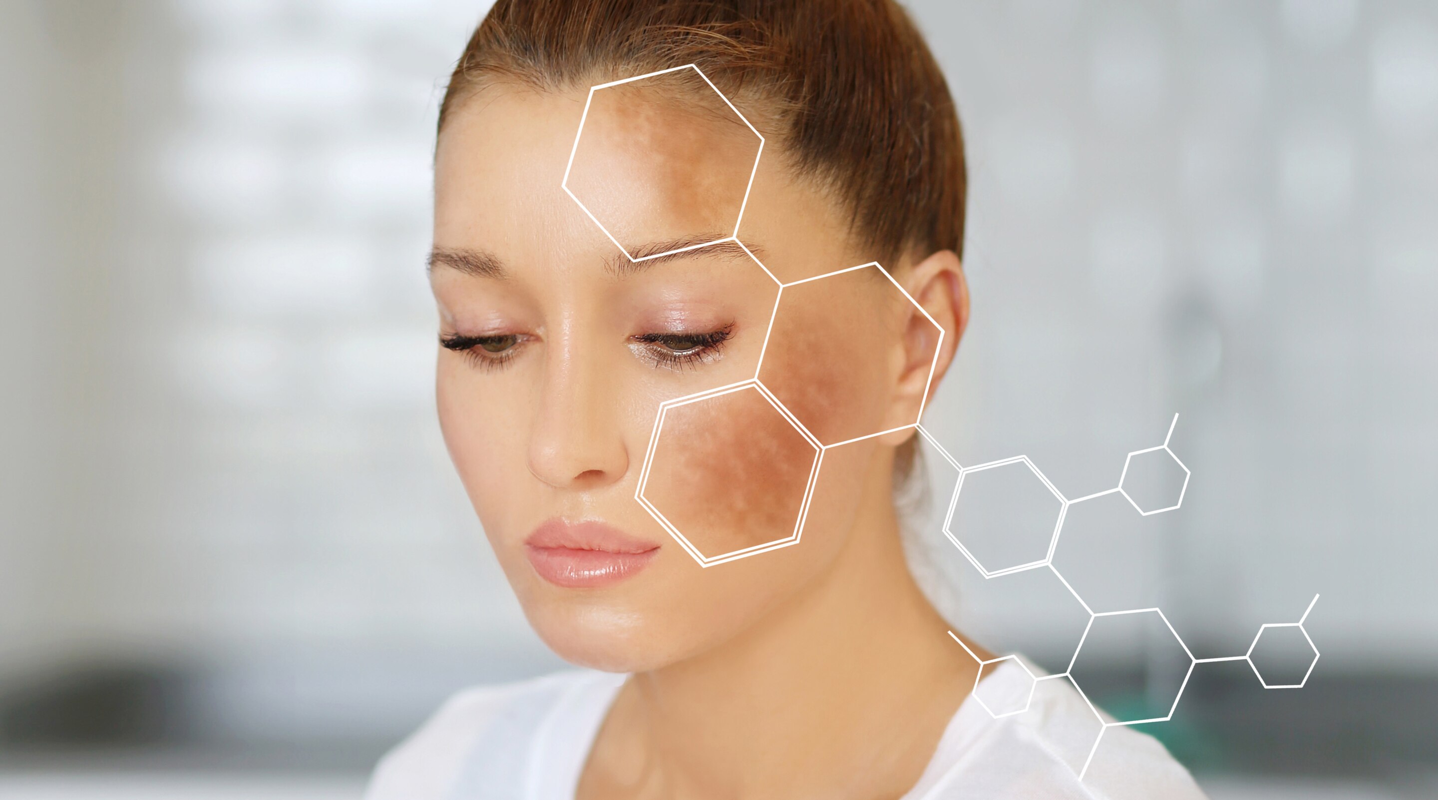 Acne Treatment Guide for Clearer, Healthier-Looking Skin