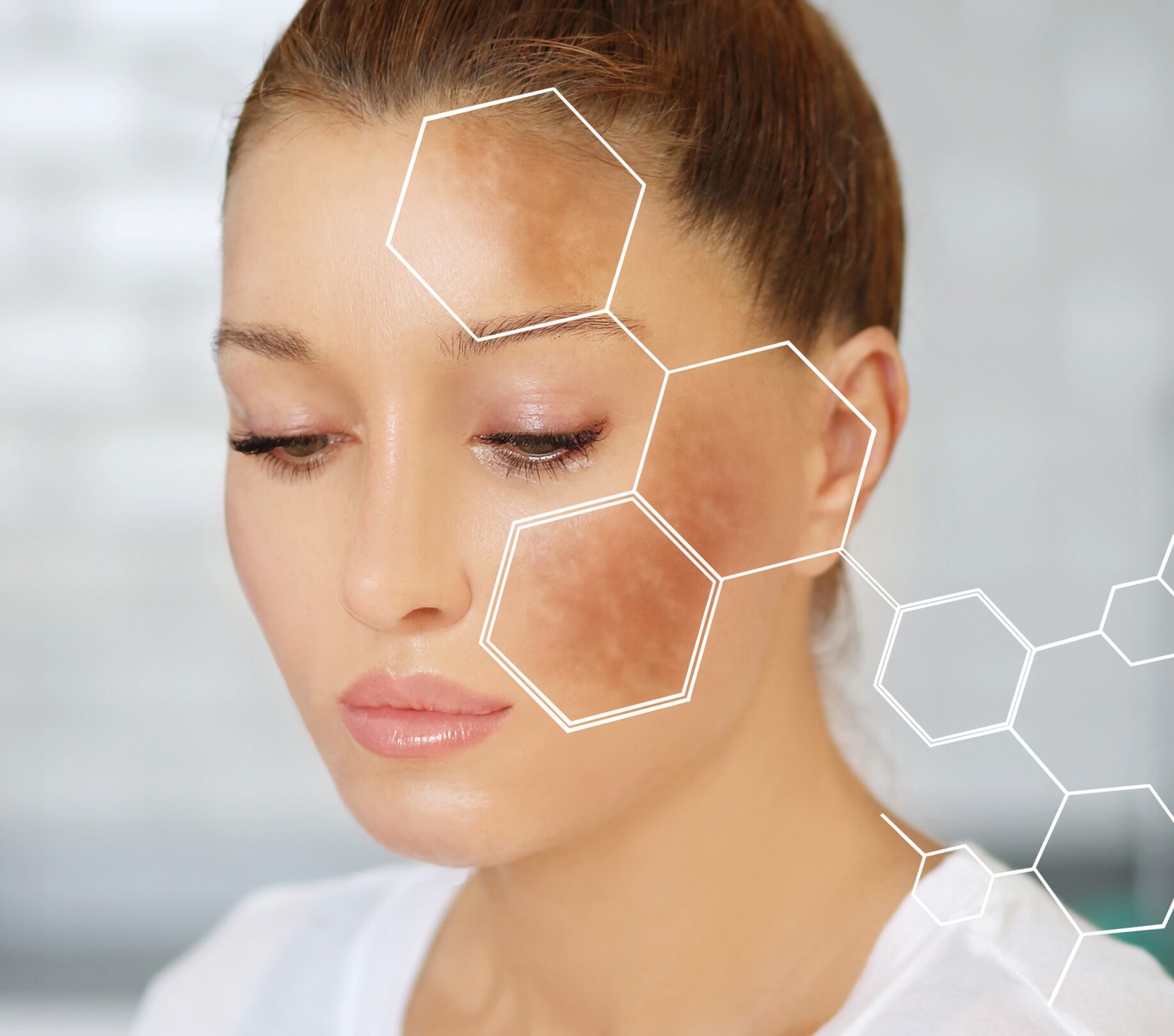 Image of Pigmentation on Face: Causes, Types, and the Right Way To Treat It