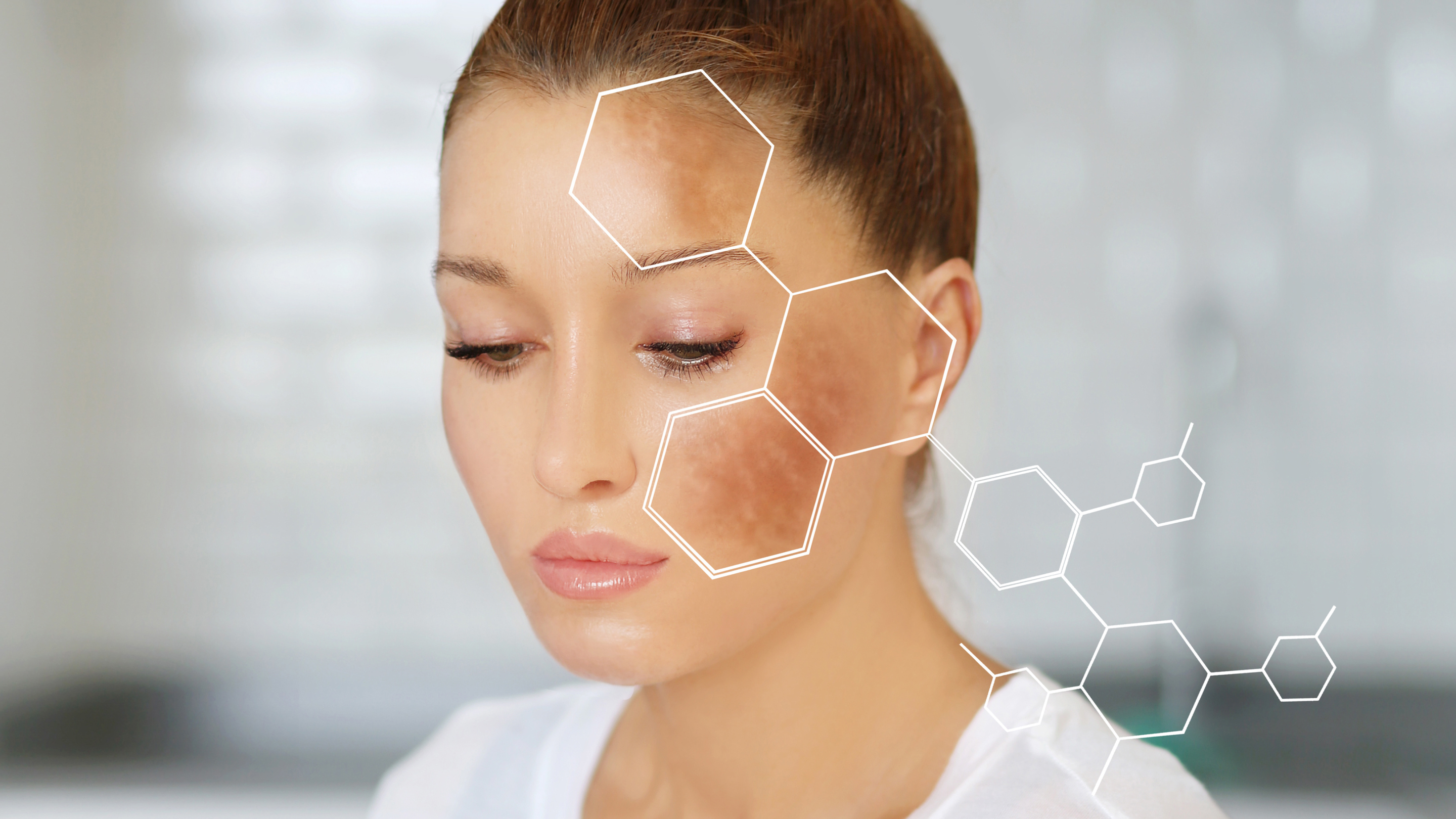 Acne Treatment Guide for Clearer, Healthier-Looking Skin