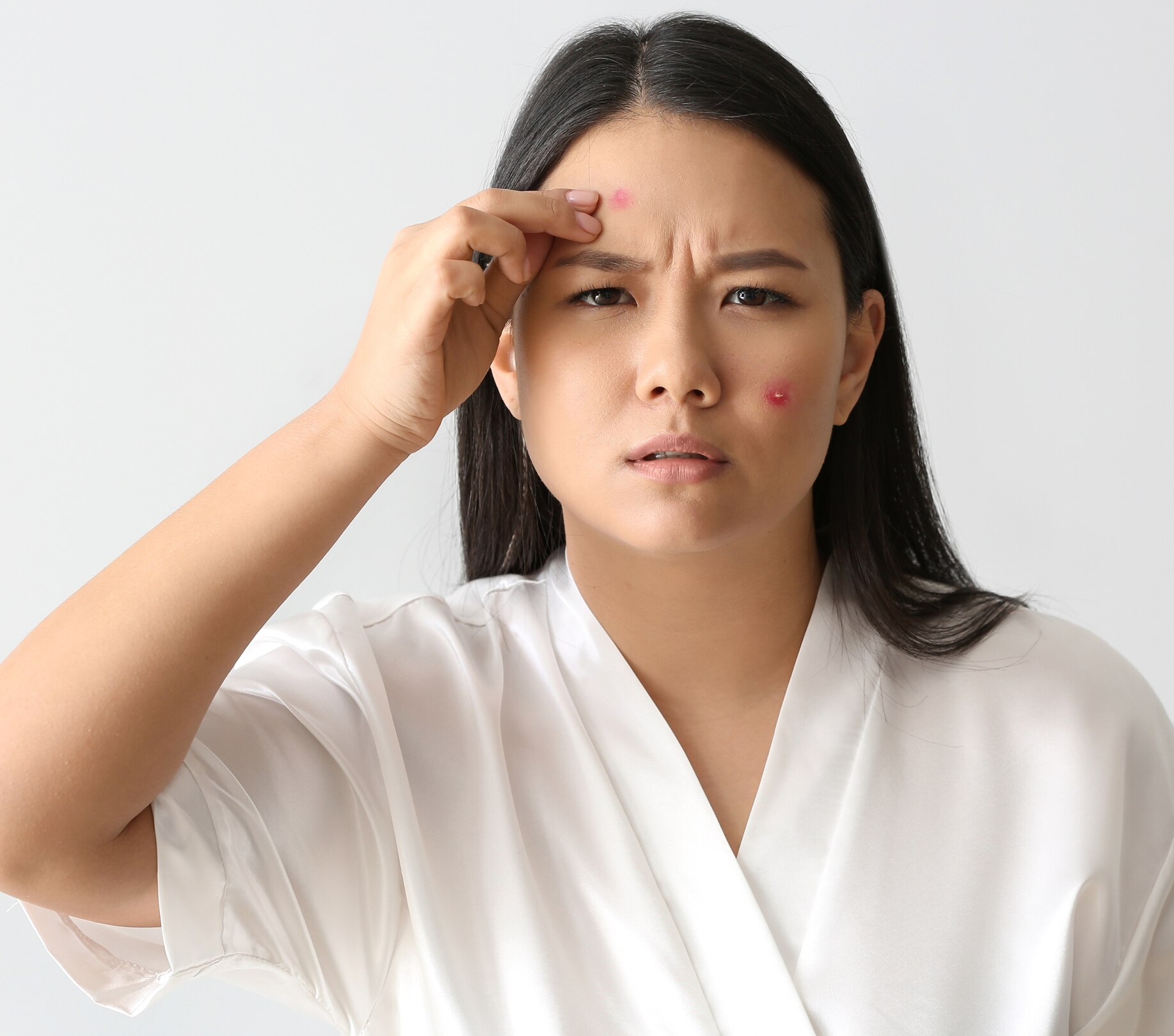 Image of Acne Spot Treatments for Active Pimples: How They Work for Indian Skin
