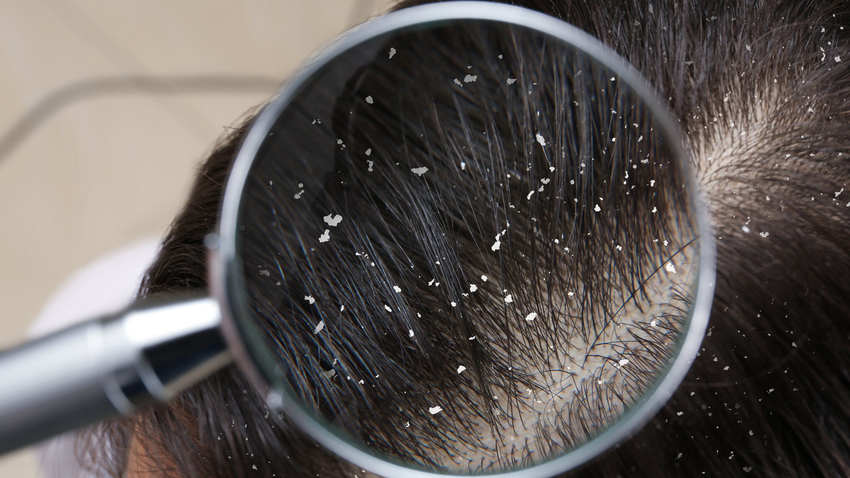Is It Right for Your Dandruff Type?