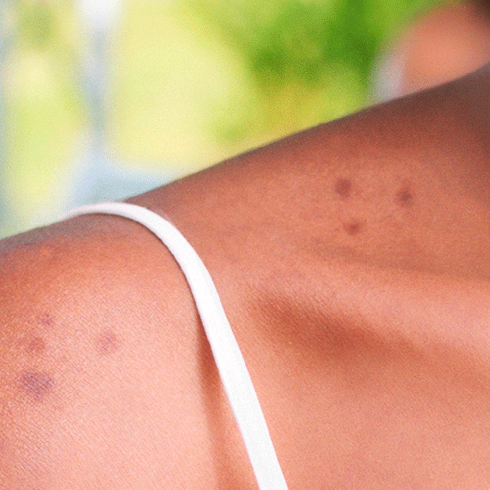 Infection Prevention: Skin Infection