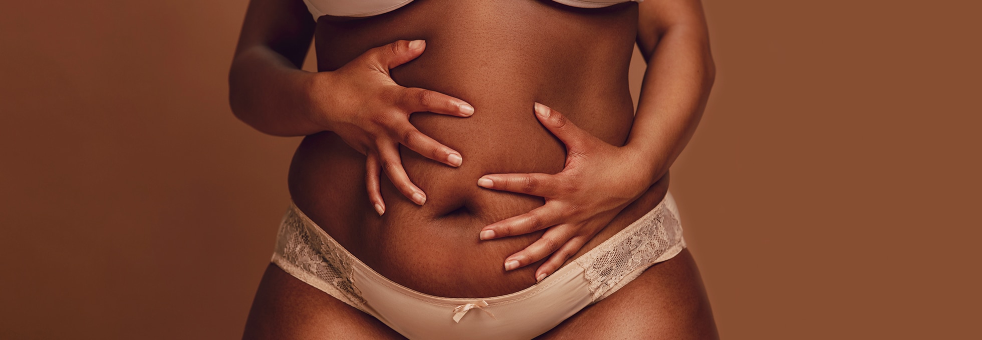 How to Deal with Stretch Marks