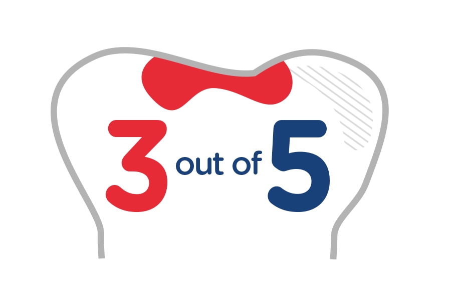Illustration of a tooth with cavities