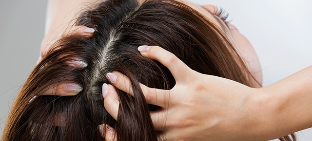 dandruff flakes in hair