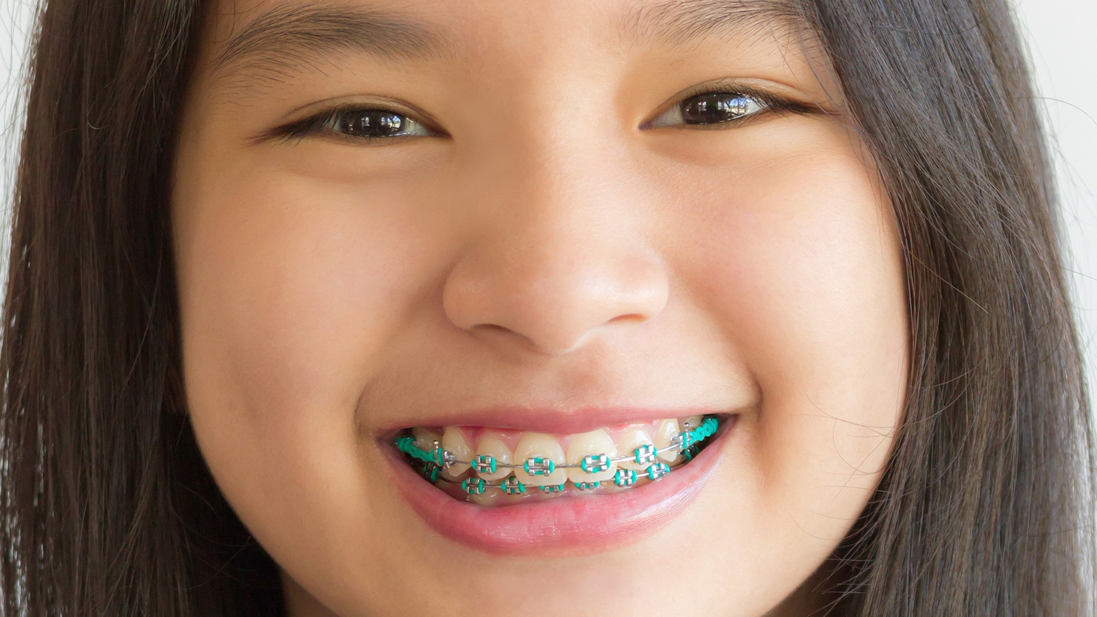 Cô gái trẻ cười trước ống kính với chiếc răng niềng răng màu xanh