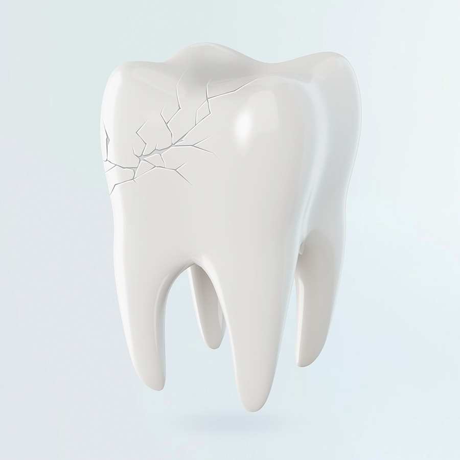 What to do if you have a fractured tooth