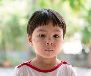 Gejala Penyakit Varisela Pada Anak