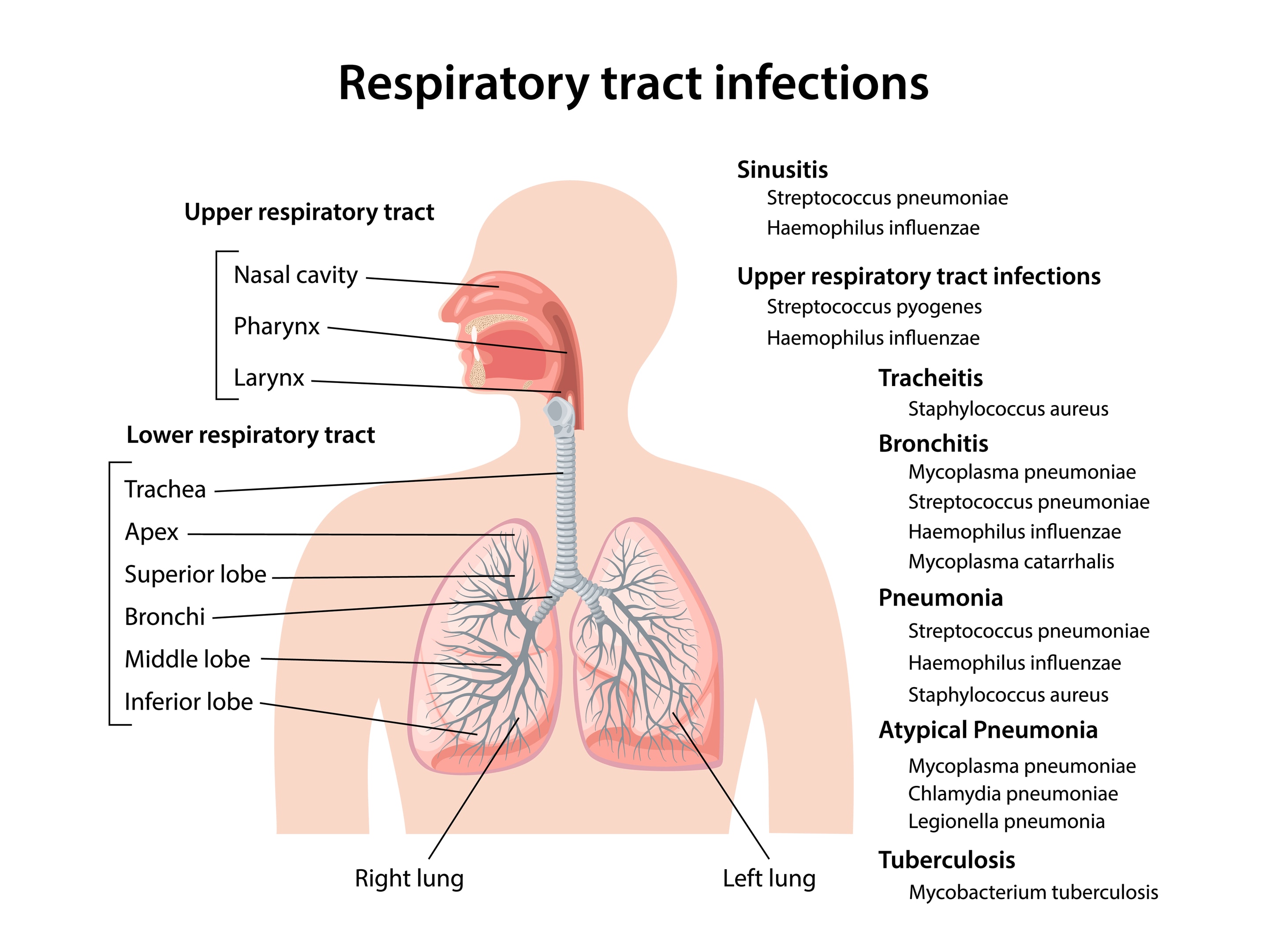 Respiratory tract Infections