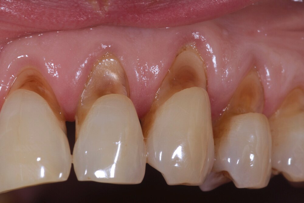 3 Tanda Bahwa Anda Mengalami Abrasi Gigi