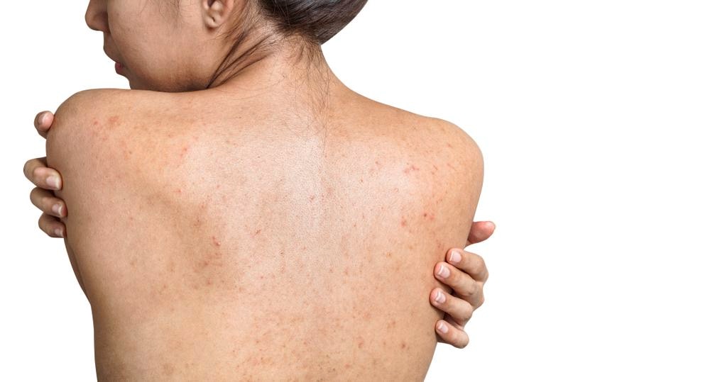 Bagaimana Cara Merawat Kulit Badan yang Berjerawat?