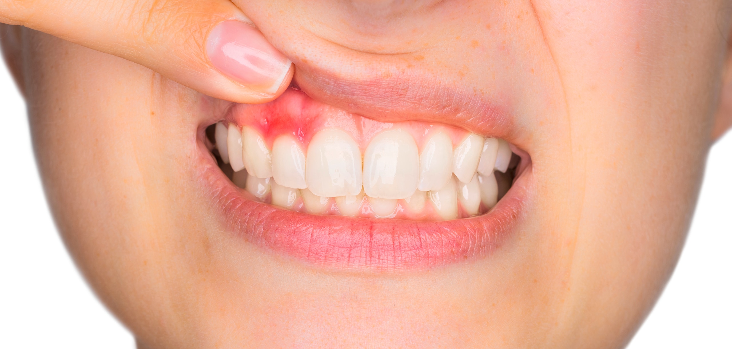 What is gingivitis and what causes it